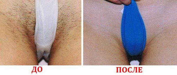 1441192152_lazernaja_jepiljacija_zony_bikini