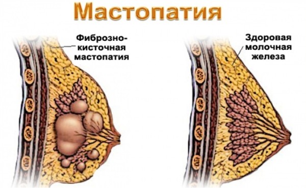 Фиброзно-кистозная мастопатия (ФКМ) молочной железы | Лечение