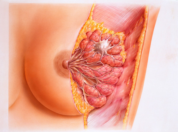 Ausschnitt eines weiblichen rechten Oberkoerpers mit Anschnitt zwischen Mamillarlinie und Axillarlinie. Weibliche Brust bzw. Brustdruese besteht aus dem Milchdruesenkoerper mit seinen Ausfuehrungsgaengen, die schliesslich in einem Ausfuehrungsgang muenden sowie Bindegewebe und Fettgewebe und obeflaechlicher Brustmuskulatur. Zu sehen ist ein grosser tumorartiger Knoten.
