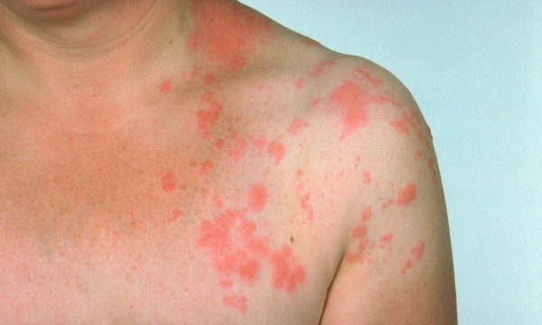 ARCWG9 Herpes zoster