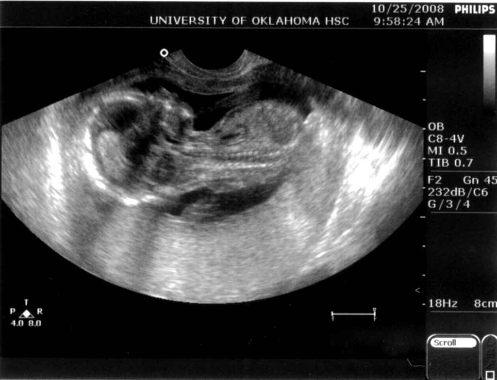 Малыш на 15 неделе беременности УЗИ