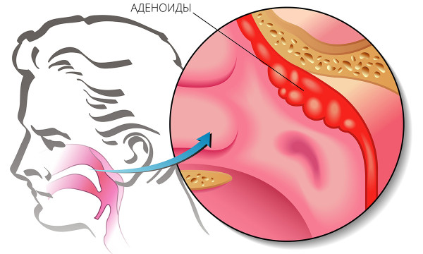 1Adenoids1200