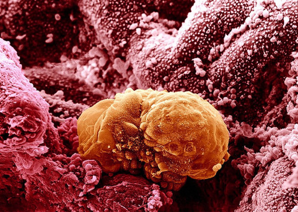 B0003308 Имплантиране на човешки ембрион на 6 дни - оцветено Кредит: Йоргос Никас.  Wellcome Images images@wellcome.ac.uk http://images.wellcome.ac.uk 6-дневен човешки ембрион започва да се имплантира в лигавицата на матката (ендометриум).  С напредването на имплантацията вътрешната клетъчна маса започва да се формира в биламинарен диск.  Двата слоя се наричат ​​епибласт и хипобласт.  Ембрион, който е бил в култура до 14 дни, ще остане на този етап от развитието.  Такива култивирани ембриони остават живи, но не напредват, както биха били в утробата.  Сканираща електронна микрография Публикувано: - Работа с авторски права, достъпна под Creative Commons by-nc-nd 2.0 UK, вижте http://images.wellcome.ac.uk/indexplus/page/Prices.html