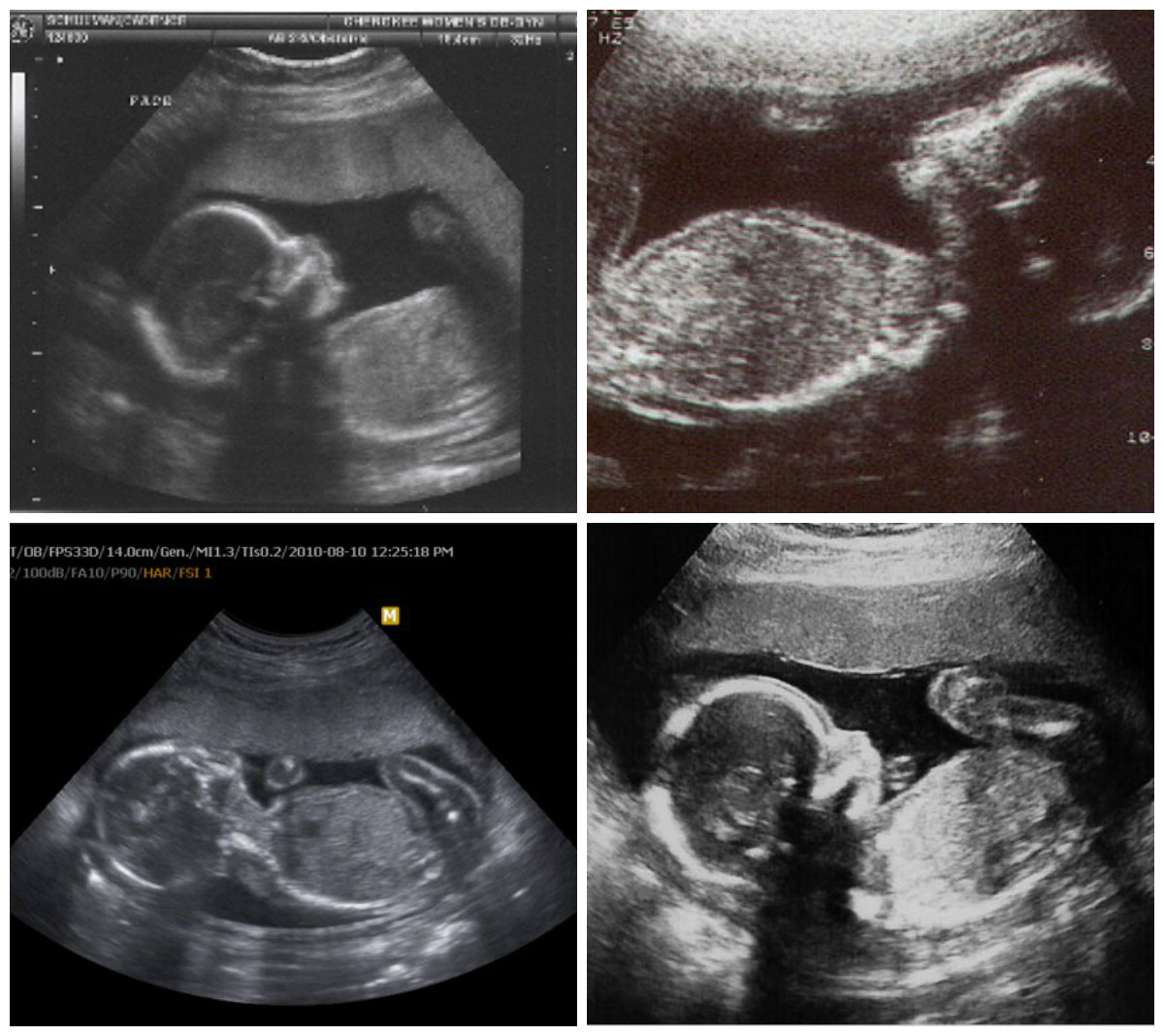 Беременность 21. УЗИ ребенка на 21 неделе беременности. Эмбрион на 22 неделе беременности. УЗИ малыша на 21 неделе беременности. Фото УЗИ ребенка на 21 неделе беременности.