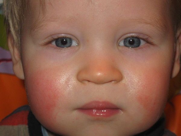 Allergiya-na-moroz-i-ee-lechenie