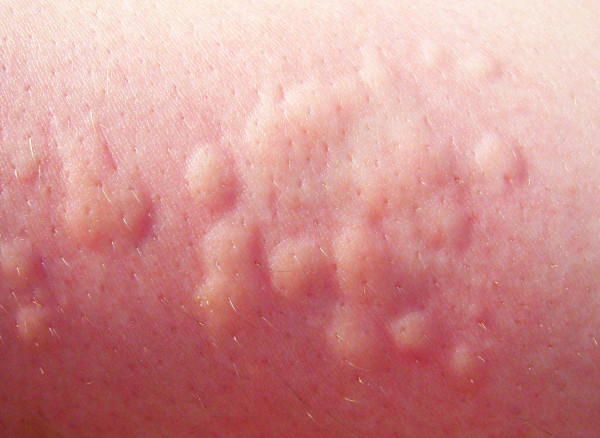 ostraa-krapivnica-1