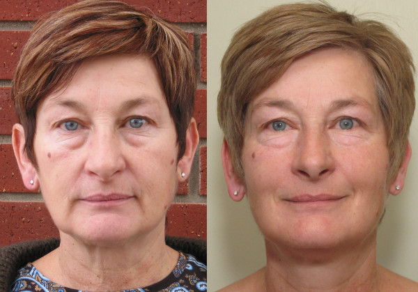 Second Chance Facials