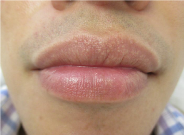 Figure-1-Fordyce-spots-on-the-upper-lip