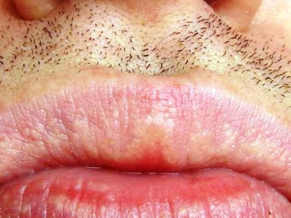 fordyce-spots-on-lips