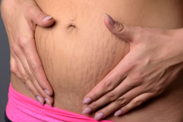 45559336 - жена покажува стрии на долниот дел на стомакот по раѓањето на детето, предизвикана од кинење на слојот на кожата на дермисот